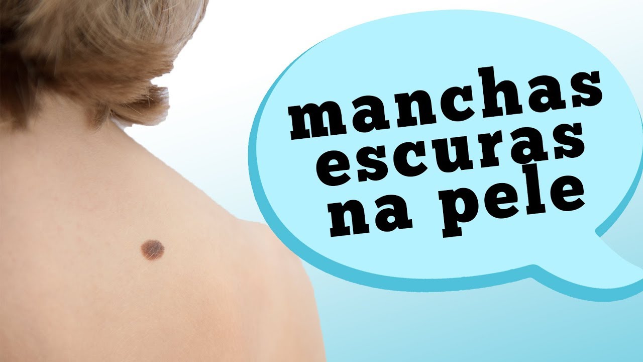 melanoma quando uma mancha escura na pela pode ser sinal de cancer maxresdefault 3 1