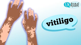 vitiligo o que e vitiligo e quando suspeitar vitiligo